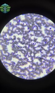 Chronic Lymphocytic Leukemia