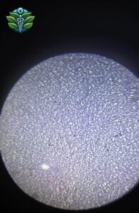 Chronic Lymphocytic Leukemia