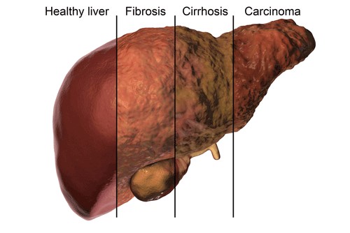fatty-liver